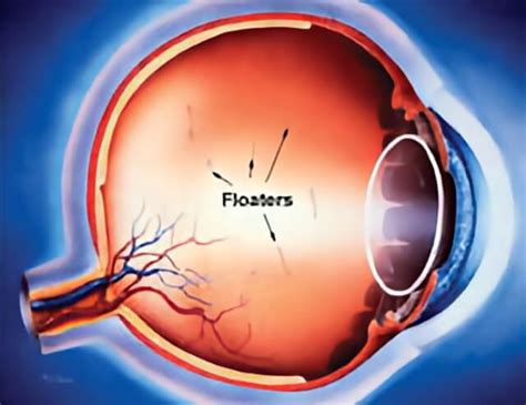 Eye Flashes And Floater Treatment Retinal Consultants Medical Group