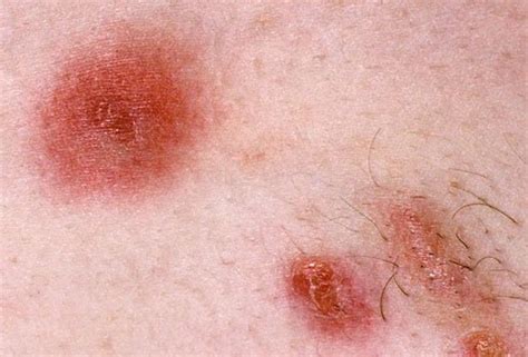 What Is Mrsa And Impetigo Signs And Symptoms Treatment Diagnosis And