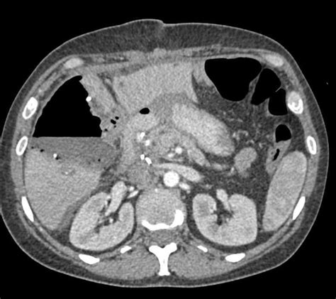 Abscess In Liver Near Resection Site Liver Case Studies Ctisus Ct