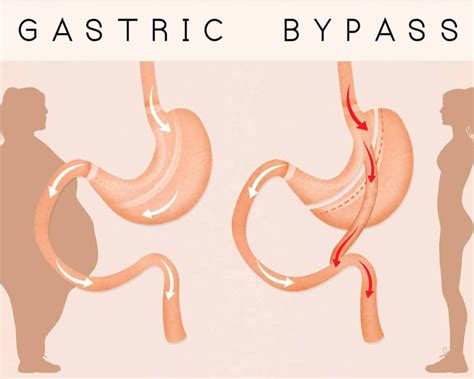 5 Tips To Prepare For Gastric Bypass Surgery Blog Bass Bariatric Surgery Bass Bariatric