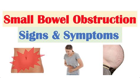 Small Bowel Obstruction Sbo Signs Symptoms Why They Occur Youtube