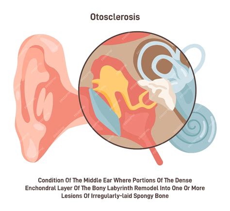 Otosclerosis Condición Médica De Los Huesos Del Oído Medio En El