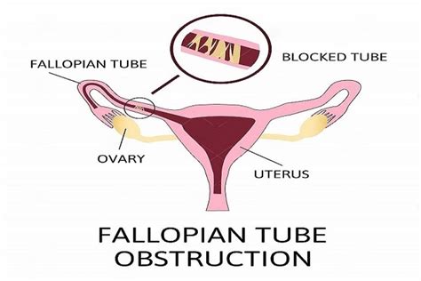 Blocked Fallopian Tubes Symptom Cause Diagnosis Treatment