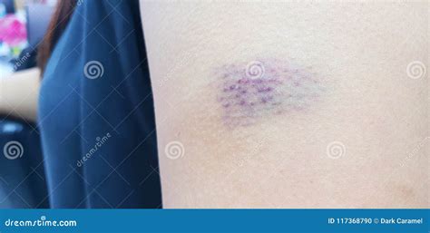 Close Up Of Bruise On A Wounded Woman Arm Stock Photo Image Of