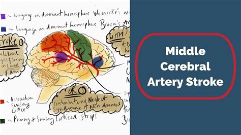 Understanding Middle Cerebral Artery MCA Strokes Symptoms And Effects
