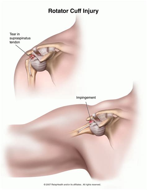You don't want to do the physiotherapy program required after surgery. Rotator Cuff Injuries