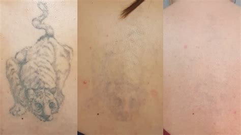 Tattoo Removal Before And After Eliminar Tatuajes Antes Y Despues