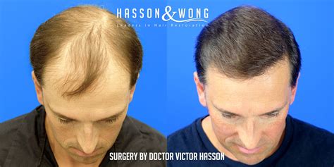 Hair Transplant Before After Some Of Our Favorite Results From 2019