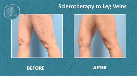Leg Vein Treatment With Foam Sclerotherapy Youtube