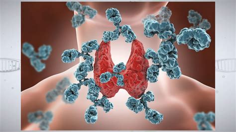 Understanding Autoimmune Thyroid Disease - Access Health