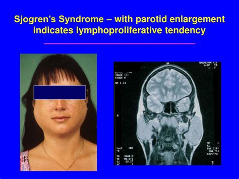 Ppt Pathogenesis Of Sjogrens Syndrome Powerpoint Presentation Free