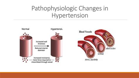 Grade 1 Hypertension Managing Stage 1 Hypertension Consider The Risks