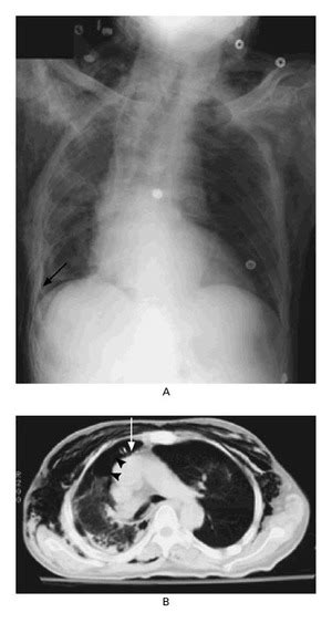 Pneumothoraces) refers to the presence of gas (often air) in the pleural space. Spontaneous Pneumothorax | NEJM