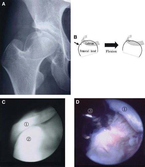 Arthroscopic Surgery To Treat Intra Articular Type Snapping Hip
