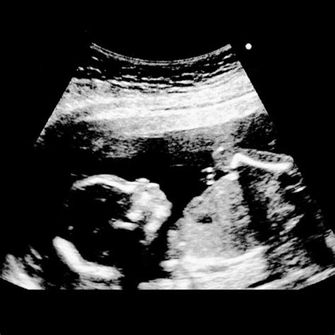 18 Ssw Überblick über Die 18 Schwangerschaftswoche