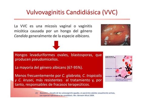 Recurrencias De La Infecciones Vaginales El ProbiÓtico Clave Para Su