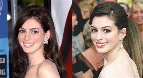 Anne Hathaway Nose Job Plastic Surgery Before And After Celebie