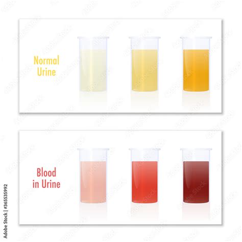Blood In Urine Color Infographic Chart Blood In Urine And Normal Urine