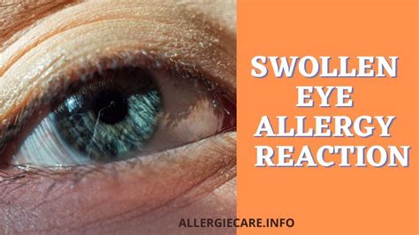 Swollen Eye Allergy Reaction And Cure By Best 5 Natural Remedies Allergie Care