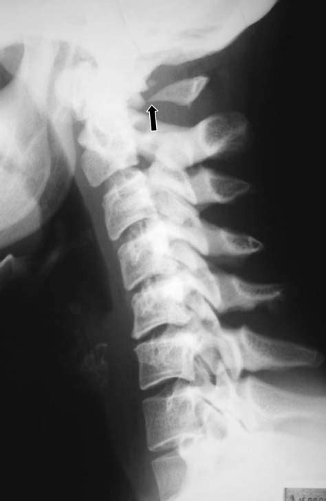Lateral Radiograph Of The Cervical Spine Reveals Aplasia Of The