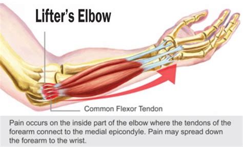 After keeping with this bicep and forearm tendinitis rehabilitation program for just over four months. How I Fixed My Lifter's Elbow