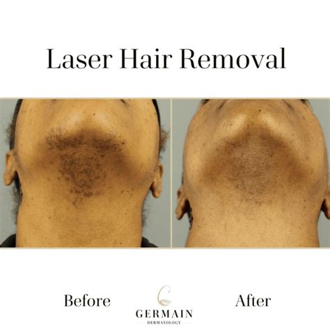 Top More Than 138 Dermatologist Laser Hair Removal Poppy