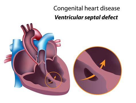 Ventricular Septal Defect Causes Types Symptoms Diagnosis Treatment