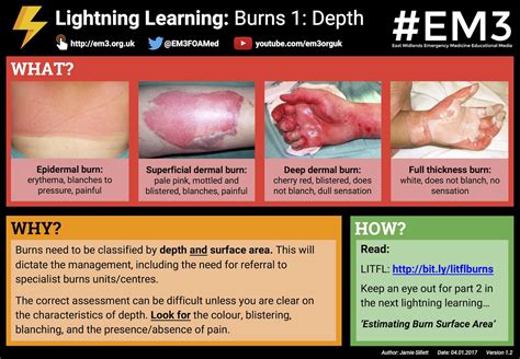 Lightning Learning Burns 1 Depth — Em3 East Midlands Emergency
