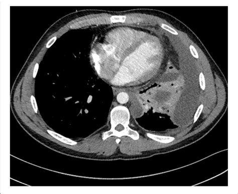 It can result from pneumonia and many other conditions. | A computed tomography (CT) scan showed a multi-loculated left pleural... | Download Scientific ...