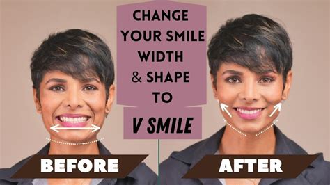 How To Change Your Smile Width And Shape To V Smile Youtube
