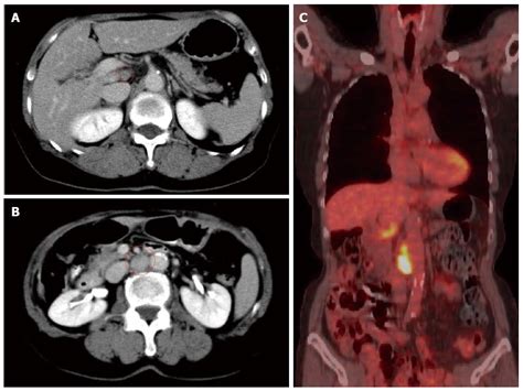 Successful Resection Of Metachronous Para Aortic Virchow Lymph Node