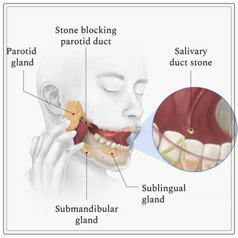 Salivary Gland Stone Symptoms And Treatment Dentist Ahmed Official