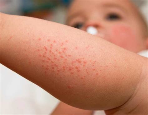 10 Common Childhood Rashes How To Treat Hives Rash Tr