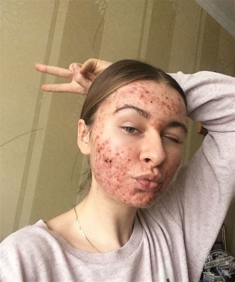Woman Inspires Others With Acne To Go Makeup Free Media Drum World