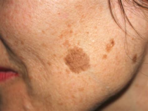 Age Liver Spots Symptoms Causes Treatment Toronto Dermatology Centre