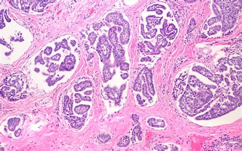 Biopsy Spotlight Inflammatory Mammary Gland Carcinoma Texas Aandm