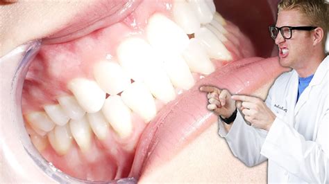 Teeth Clenching Grinding And Bruxism Causes Remedies And Treatments To