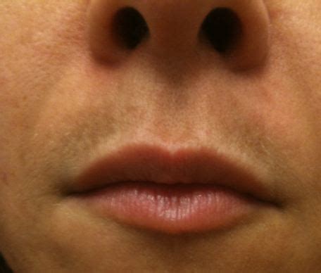 Melasma is also called chloasma faciei or the mask of pregnancy, which is common in women, particularly pregnant women and people who are using basil leaves regularly may help to get rid of melasma naturally and decrease dark spots on the skin26 27. Dark Upper Lip - Causes of Dark Skin on Upper Lip Shadow ...