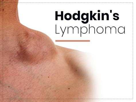Hodgkins Lymphoma Types Symptoms Causes Risk Factors Diagnosis