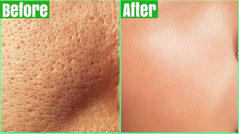 How To Get Rid Of Large Pores Permanently 100 Works Shrink And Get Clear Glass Skin Naturally