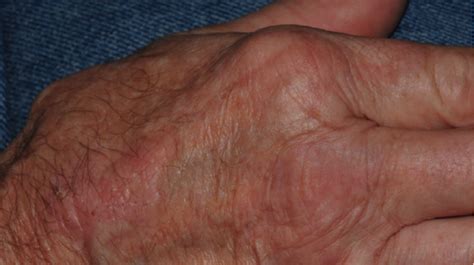 68 Year Old Man With Itchy Rash On Both Hands The Doctors Channel