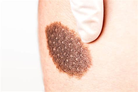 Basal Cell Carcinoma Stock Photos Pictures And Royalty Free Images Istock