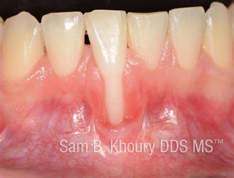 Gum Grafts Before And After Dr Sam Khoury