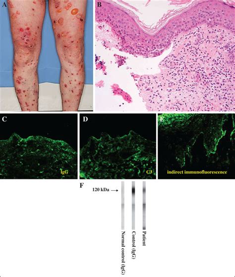 Jle European Journal Of Dermatology A Case Of Delgocitinib Indued