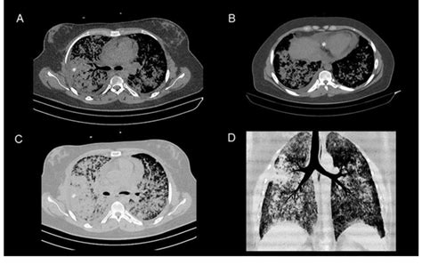Computerized Tomography Ct Of The Thorax Thoracic Ct Scan Without