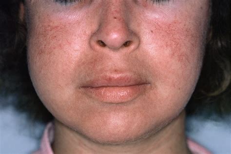 Severe Rosacea Associated With High Out Of Pocket Treatment Costs