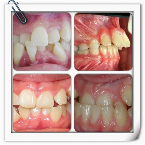 Pendakap gigi (braces) jenis ini adalah yang paling popular dan biasanya apa yang kita bayangkan apabila kita mendengar perkataan braces atau pendakap gigi. YOUR FAMILY DENTIST: PENDAKAP GIGI / BRACES