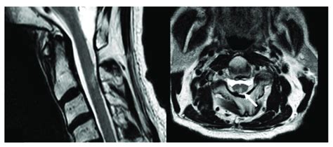 T2 Weighted Magnetic Resonance Imaging Of The Cervical Spine Of Patient