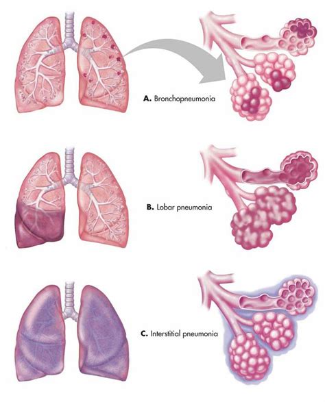 Types Of Pneumonia Medical Anatomy Medical Pharmacology Nursing