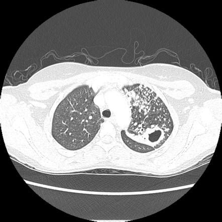 Tuberculosis Pulmonary Manifestations Radiology Reference Article